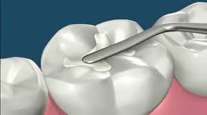 Procédures de restaurations